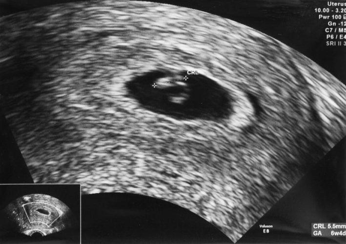 Photo - échographie à 5-6 semaines de grossesse