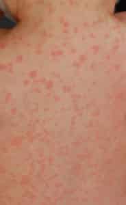 Photo - éruption cutanée (rash) à la suite d'une réaction allergique
