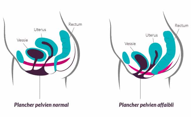 Image - plancher pelvien normal versus plancher pelvien affaibli