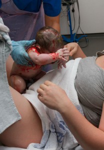 Photo - Accouchement à l'hôpital, bébé naissant, position d'accouchement - Billet Le périnée, ce grand oublié : La vision de Dr de Gasquet