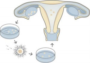Photo : Infertilité : Fécondation in-vitro