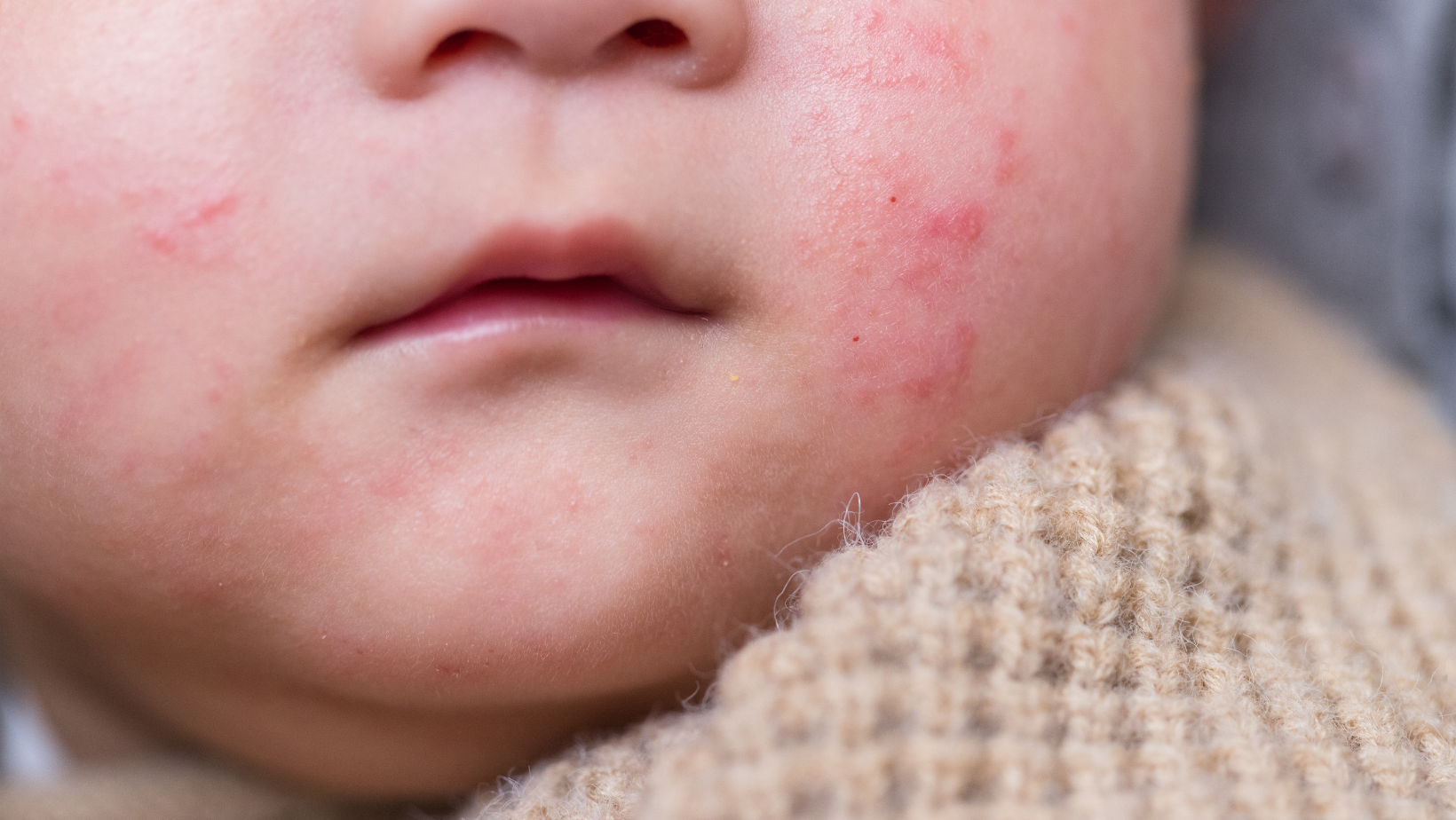 Photo - bébé avec des taches sur la peau